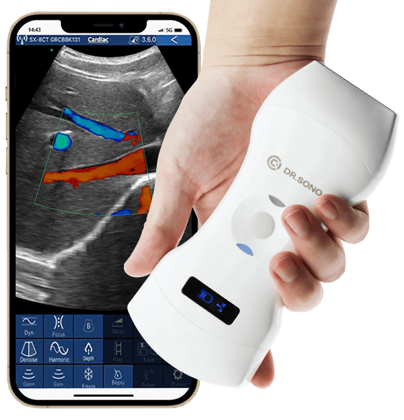 Handheld-Wireless-Ultrasound-Scanner