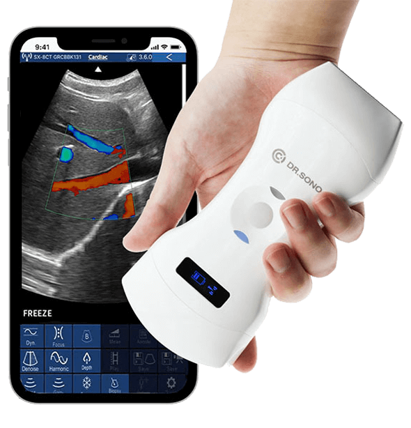 Handheld Wireless Ultrasound Scanner