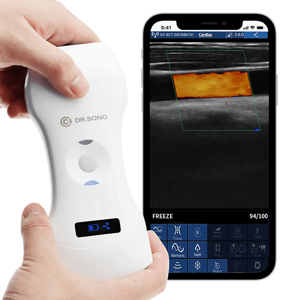 handheld wirelss ultrasound