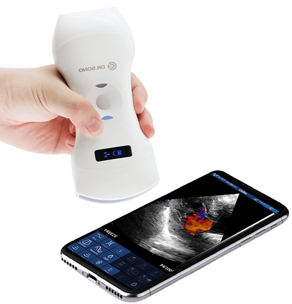 Portable & Wireless Ultrasound Scanner