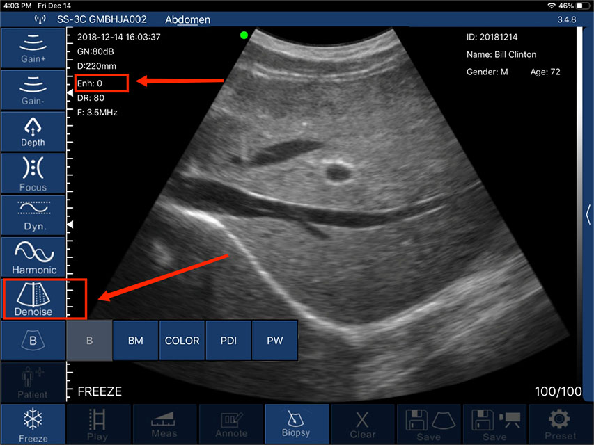 Denoise -DRSONO portable ultrasound scanner