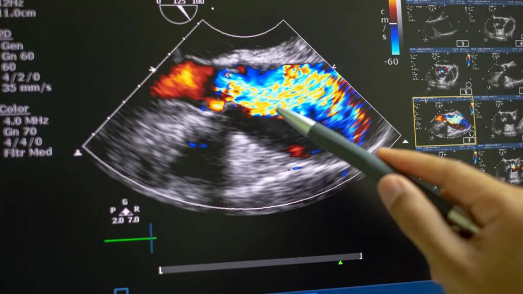 color Doppler imaging technique-How to Read an Ultrasound
