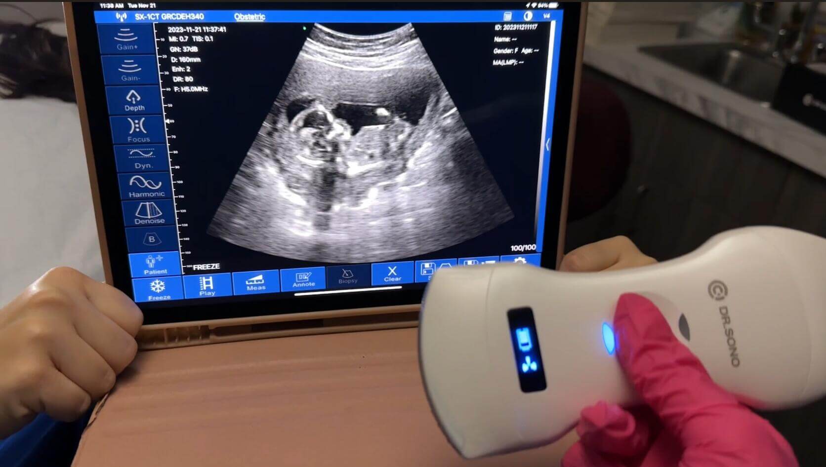 fetal ultrasound on pregnant women-How to Read an Ultrasound