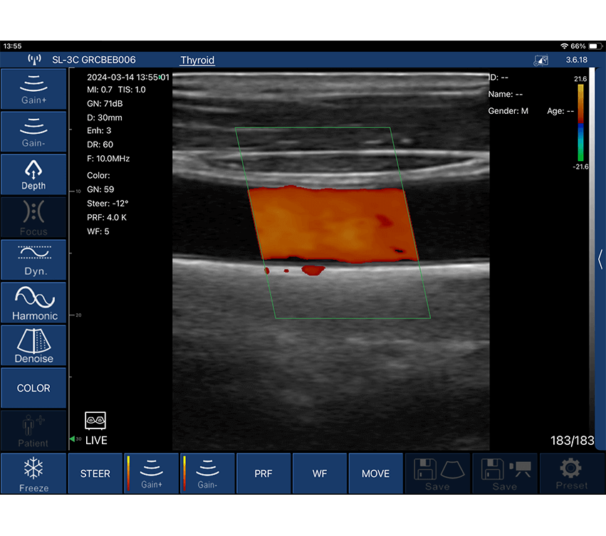 Pocus -Linear Probe Produces Clear Vascular Imaging