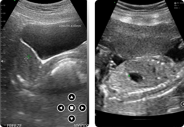DRSONO Tragbares Ultraschallgerät Gynäkologie