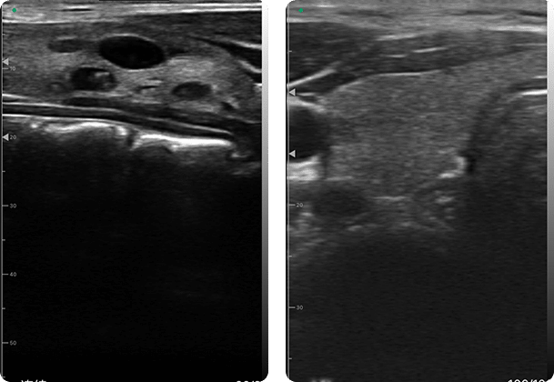 DRSONO Handheld-Ultraschallgerät Schilddrüse