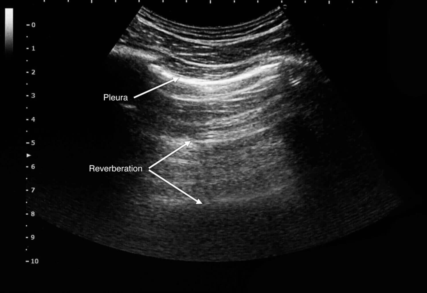 Pleura-Reverberación