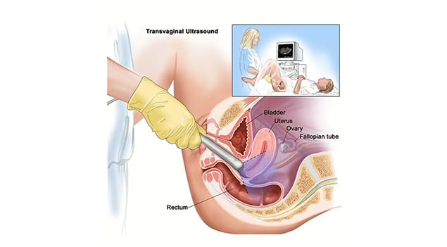 transvaginaler Ultraschall