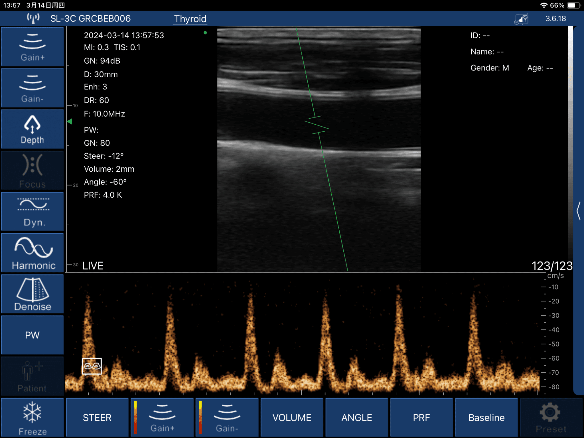 Carotid Artery