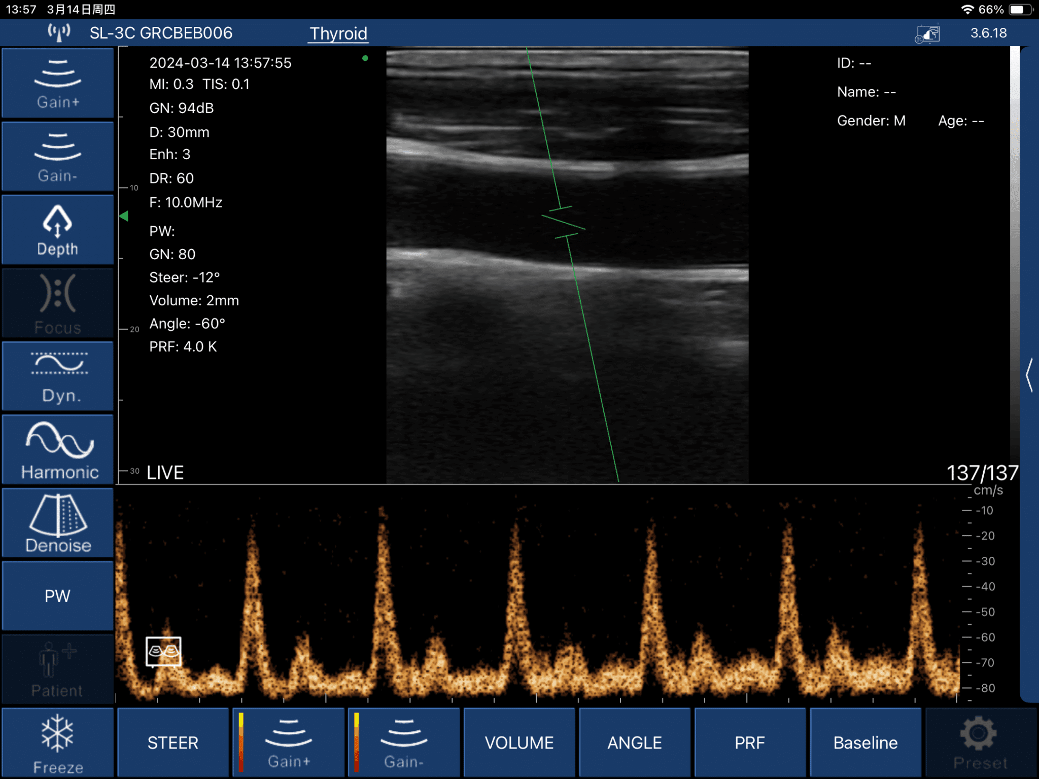 Carotid Artery