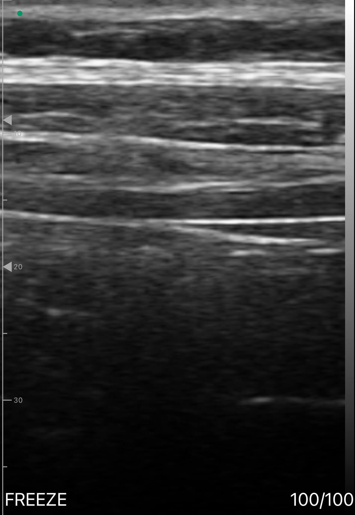 Transverse Abdominal Muscle